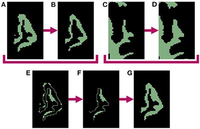 Synthetic Atrophy for Longitudinal Cortical Surface Analyses